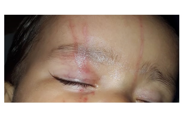 Criança volta da creche com lesões no rosto e entidade adota providências a respeito
